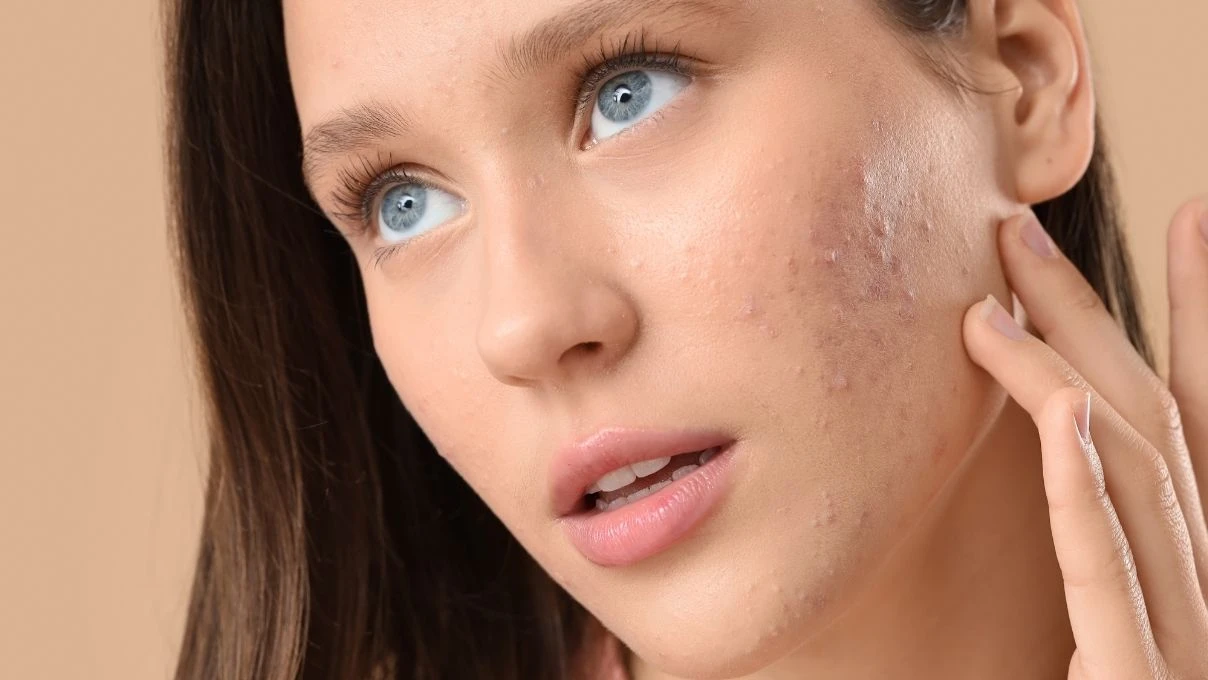 Cilt lekelerini azaltan doğal maske! Evde yapabilirsiniz