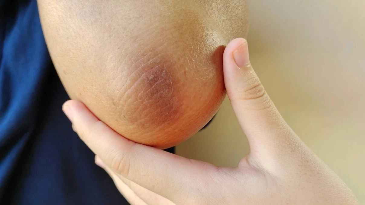 Diz ve dirsek kararmalarına evde çözüm! Toz şeker ve Hindistan cevizi yağı