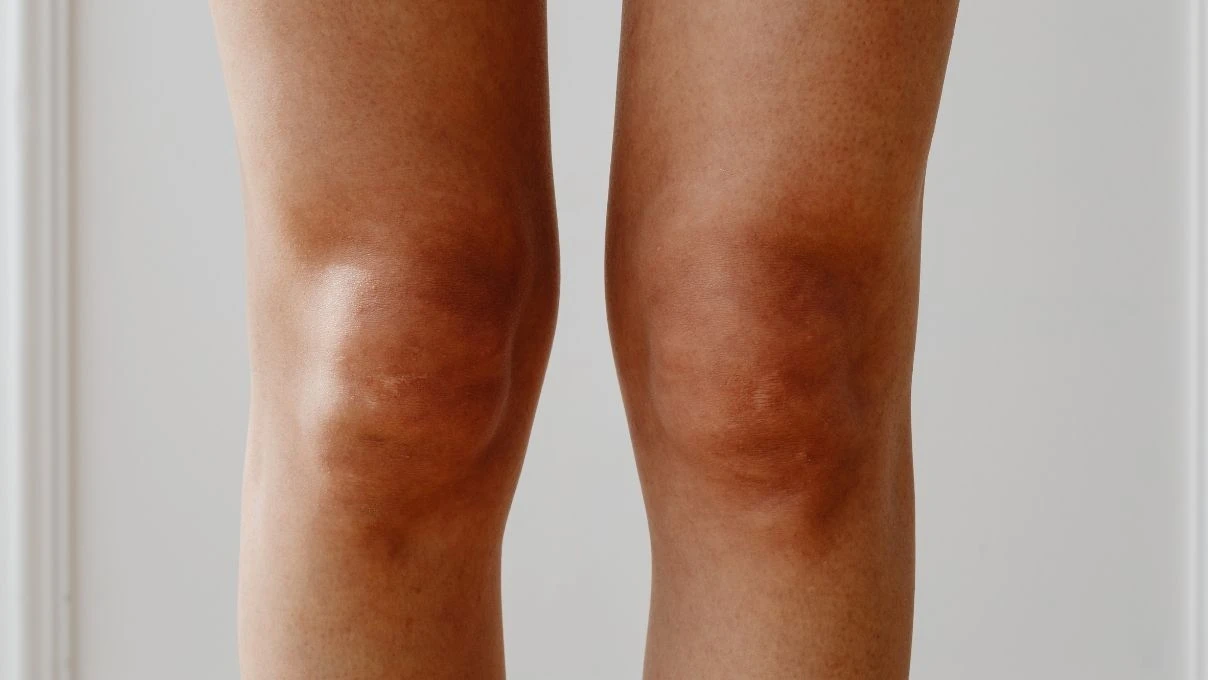 Diz ve dirsek kararmalarına evde çözüm! Toz şeker ve Hindistan cevizi yağı