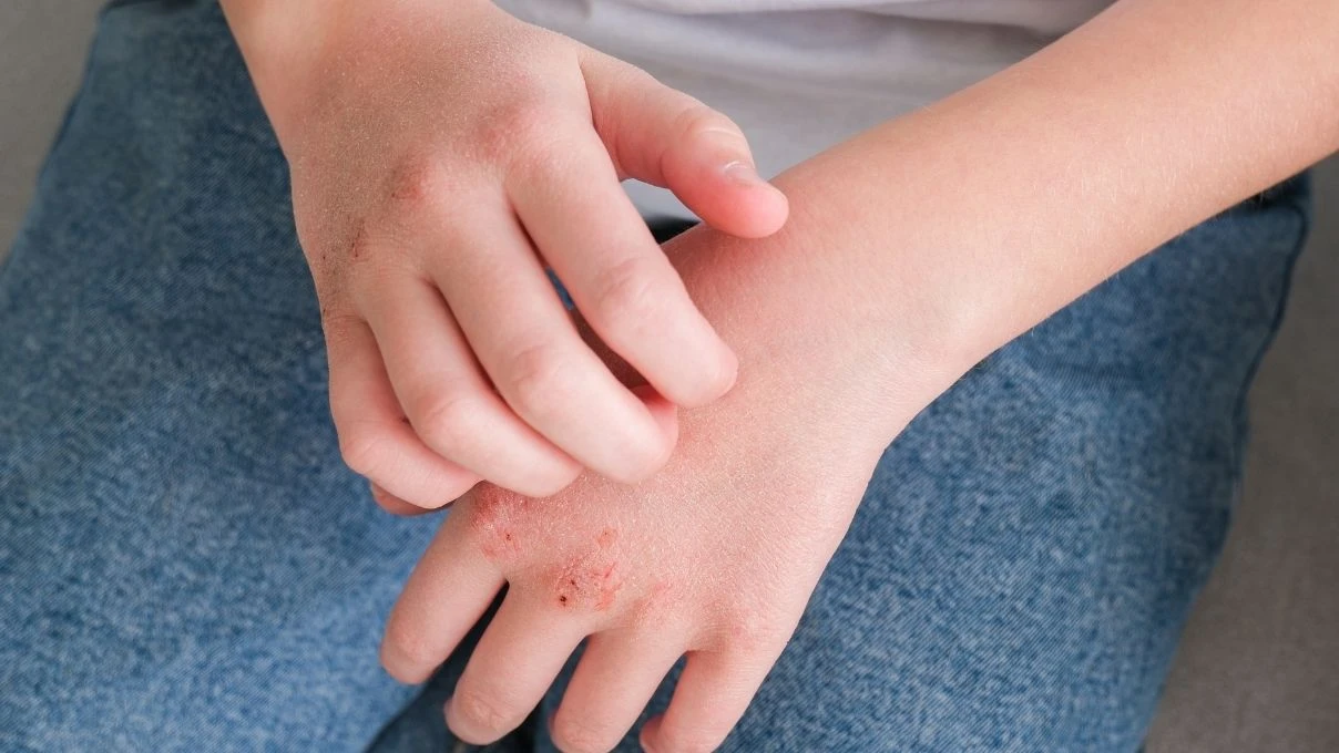 Susuz kalan cilt için iftarda tüketilmesi gereken besinler! Döküntü kaşıntı artıyor