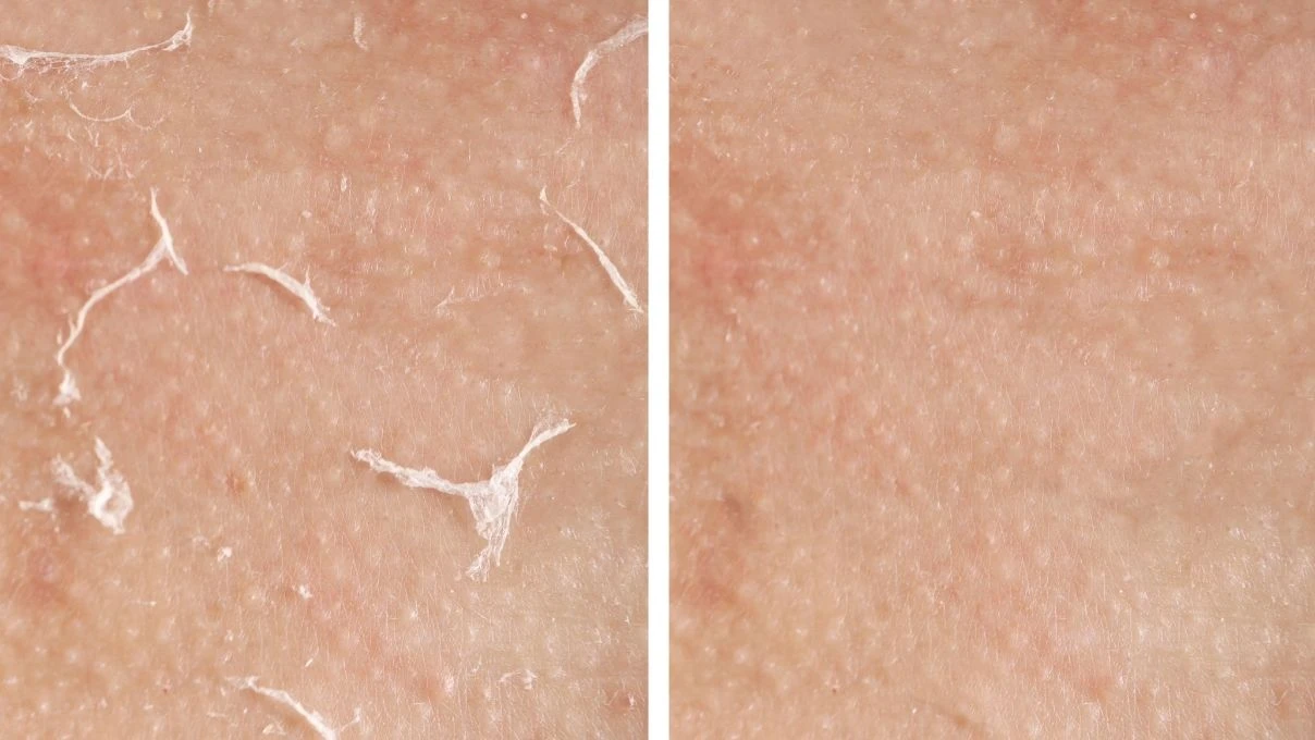 Susuz kalan cilt için iftarda tüketilmesi gereken besinler! Döküntü kaşıntı artıyor