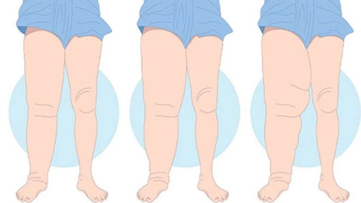 Lipödeme dikkat sinsi sinsi ilerliyor! Kadınların gizli kabusu