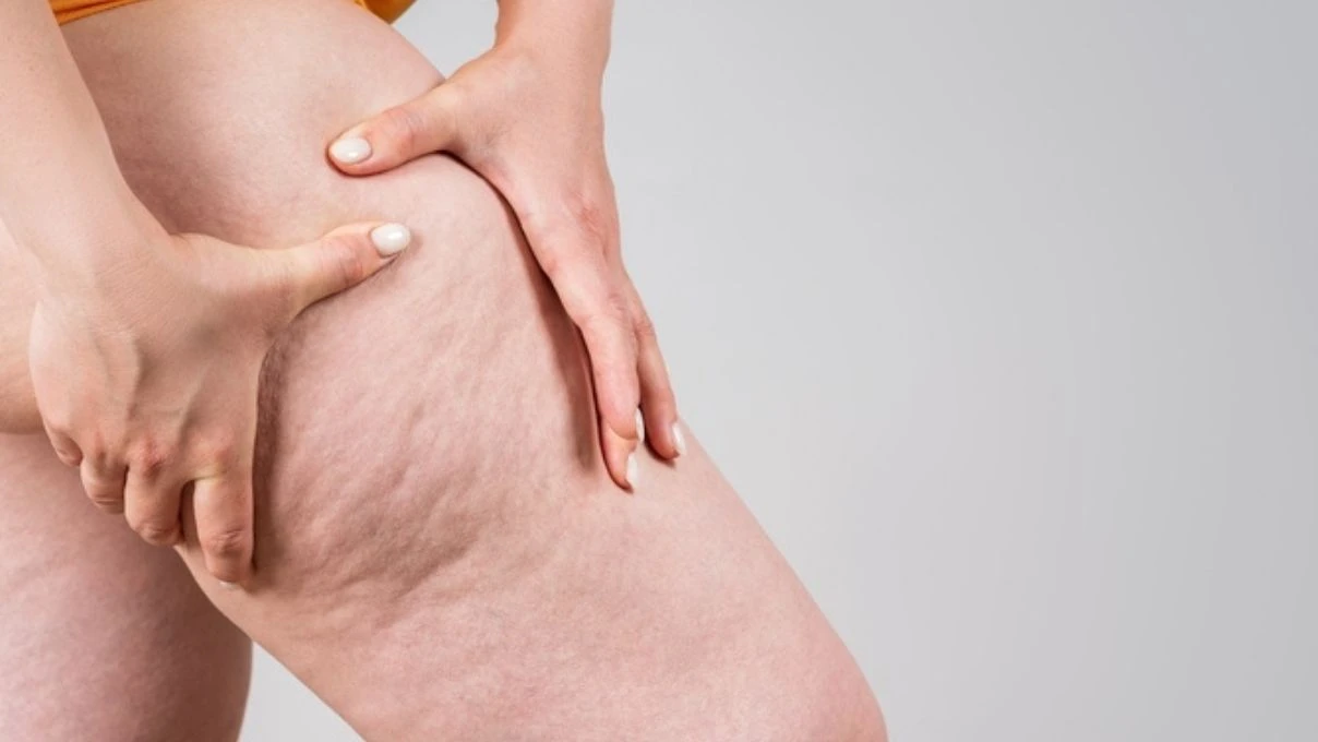 Lipödeme dikkat sinsi sinsi ilerliyor! Kadınların gizli kabusu