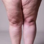 Lipödeme dikkat sinsi sinsi ilerliyor! Kadınların gizli kabusu