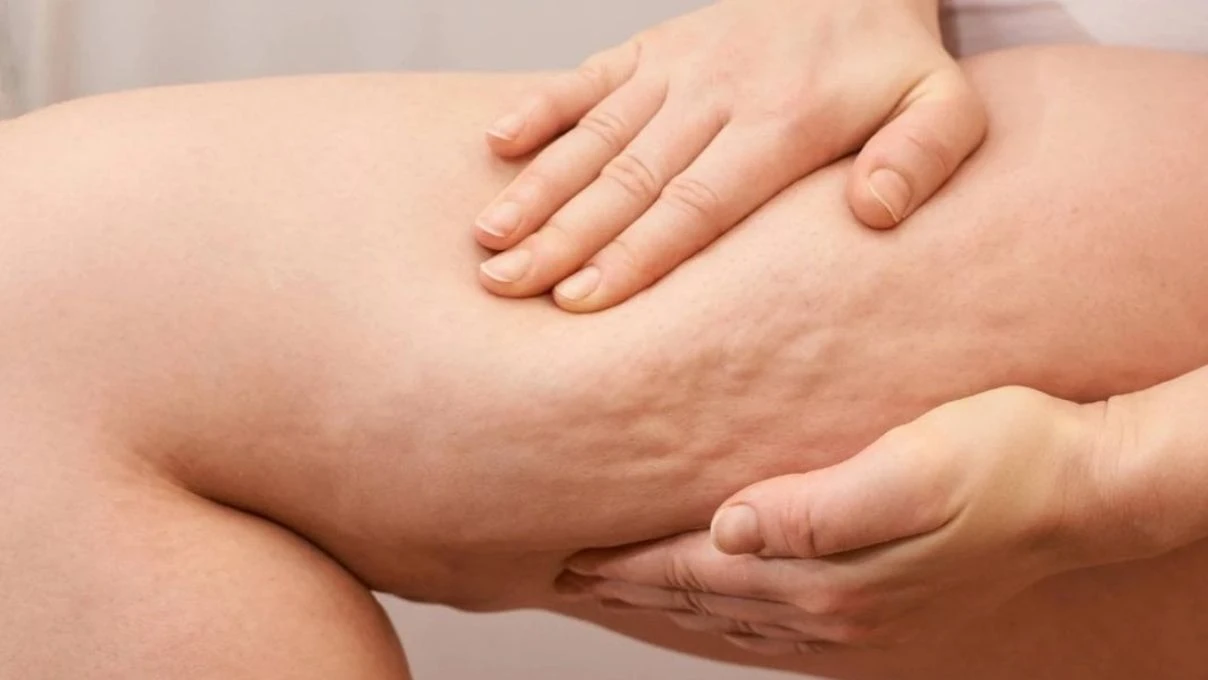 Lipödeme dikkat sinsi sinsi ilerliyor! Kadınların gizli kabusu