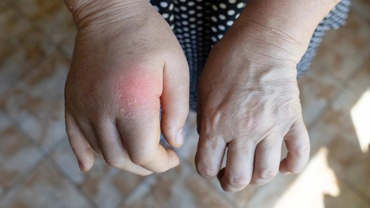 Ödem atan 7 besin! Kilolu değilsiniz şişkinsiniz 5 Ödem atan 7 besin! Kilolu değilsiniz şişkinsiniz