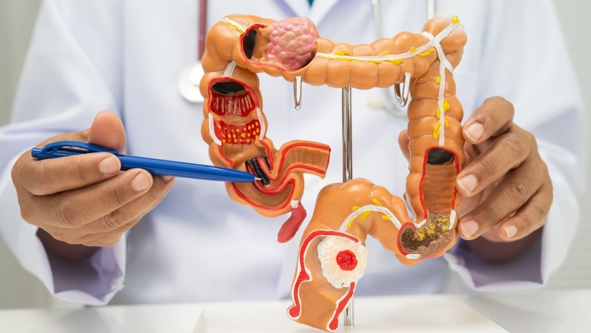 Basur sanılan belirti kanserin habercisi olabilir! İşte uzman isimden uyarılar