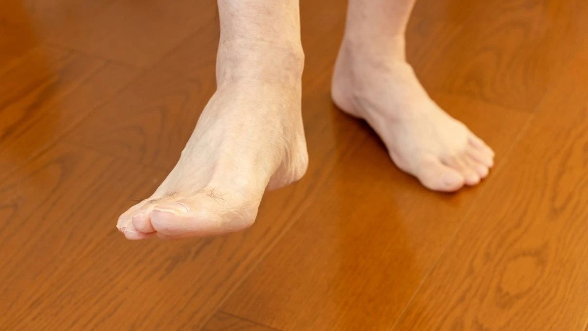 Kadınlarda ayak şişmesi neyin habercisi! Çorap izi çıkıyorsa aman dikkat 