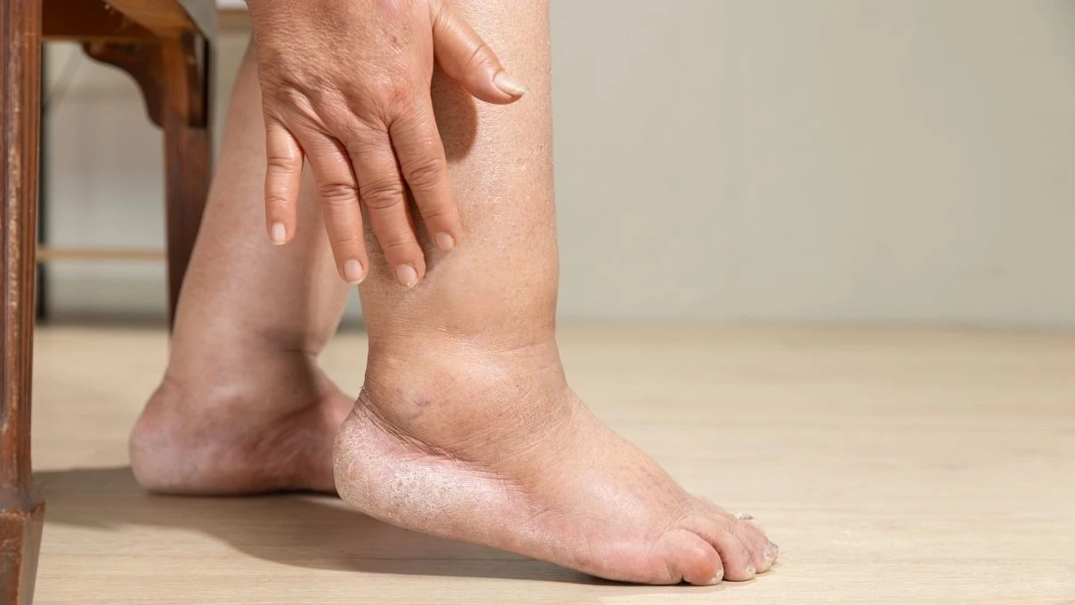 Kadınlarda ayak şişmesi neyin habercisi! Çorap izi çıkıyorsa aman dikkat 