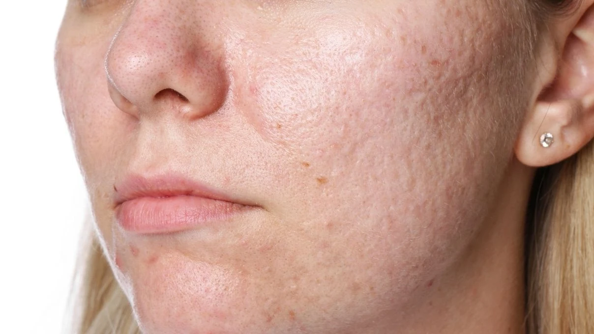 Burun ve yanaklardaki gözenekleri küçücük yapacak karışım! 30 yaşından önce başlayın