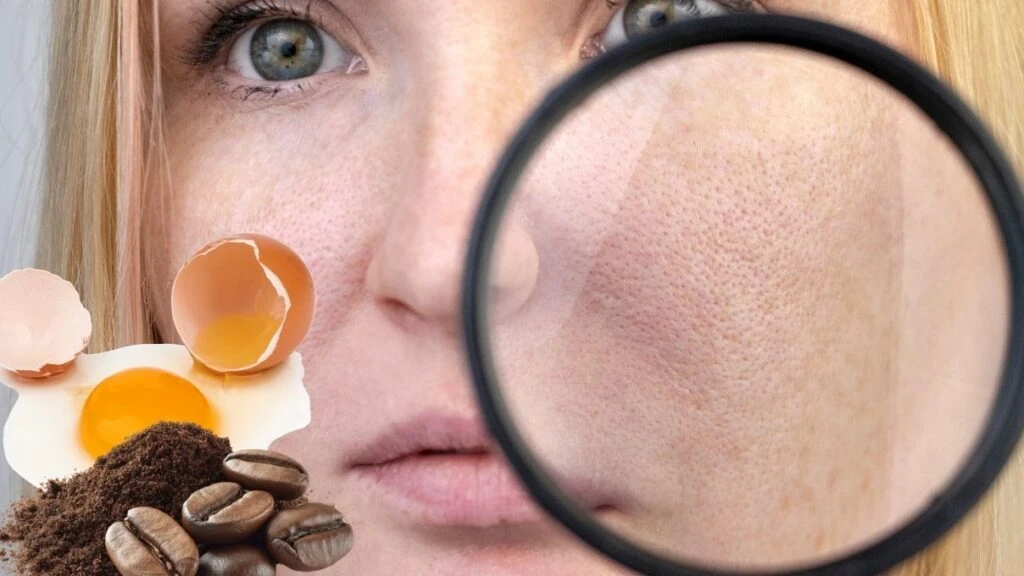 Burun ve yanaklardaki gözenekleri küçücük yapacak karışım! 30 yaşından önce başlayın