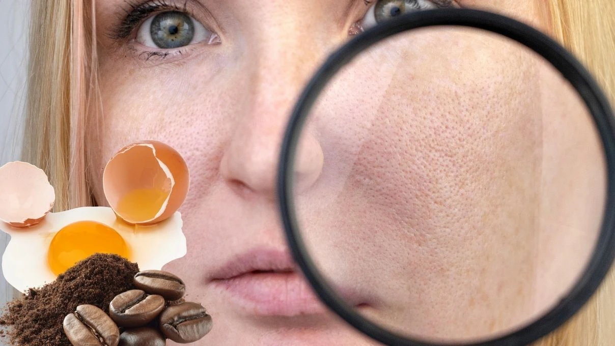 Burun ve yanaklardaki gözenekleri küçücük yapacak karışım! 30 yaşından önce başlayın