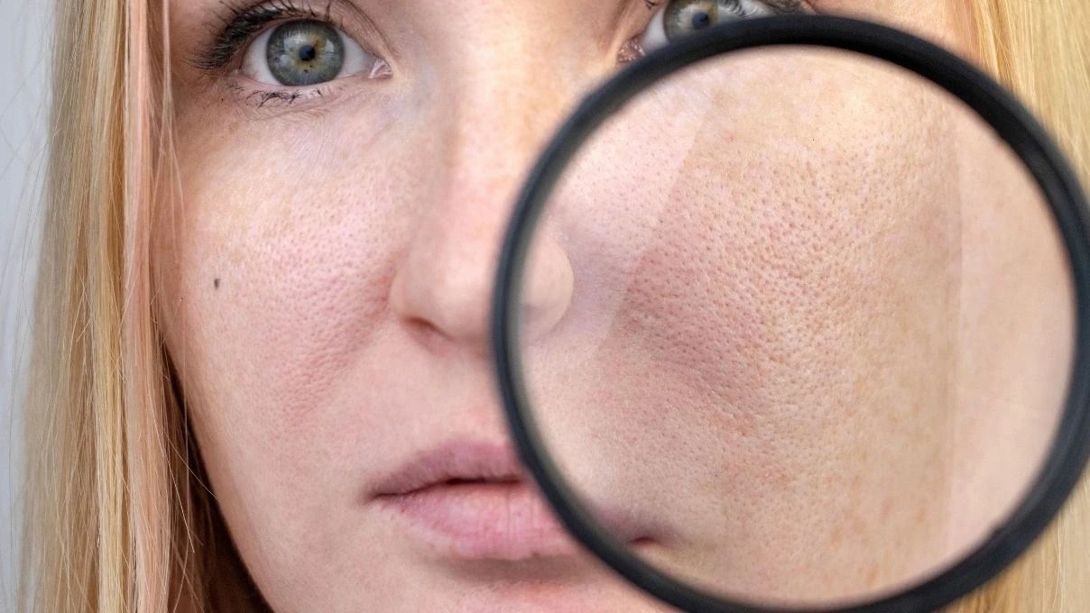 Burun ve yanaklardaki gözenekleri küçücük yapacak karışım! 30 yaşından önce başlayın