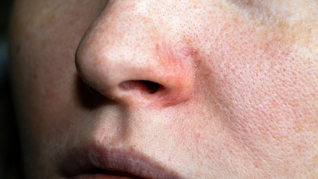 Burun ve yanaklardaki gözenekleri küçücük yapacak karışım! 30 yaşından önce başlayın