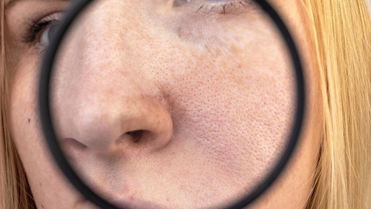 Burun ve yanaklardaki gözenekleri küçücük yapacak karışım! 30 yaşından önce başlayın