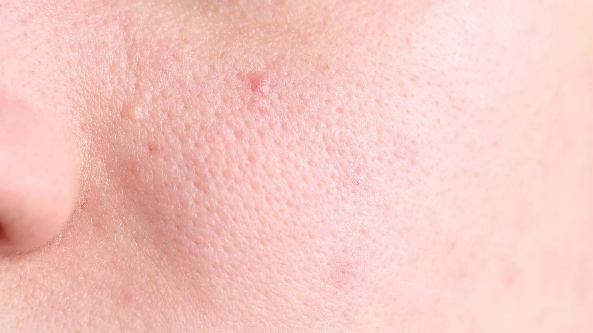 Burun ve yanaklardaki gözenekleri küçücük yapacak karışım! 30 yaşından önce başlayınBurun ve yanaklardaki gözenekleri küçücük yapacak karışım! 30 yaşından önce başlayın