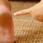 Topuk çatlaklarına asırlık çözüm! Bebek teni gibi yapıyor