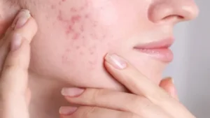 6555 tiktokta virus gibi yayinlan sivilceye sarimsak surme akimi tehlike mi saciyor