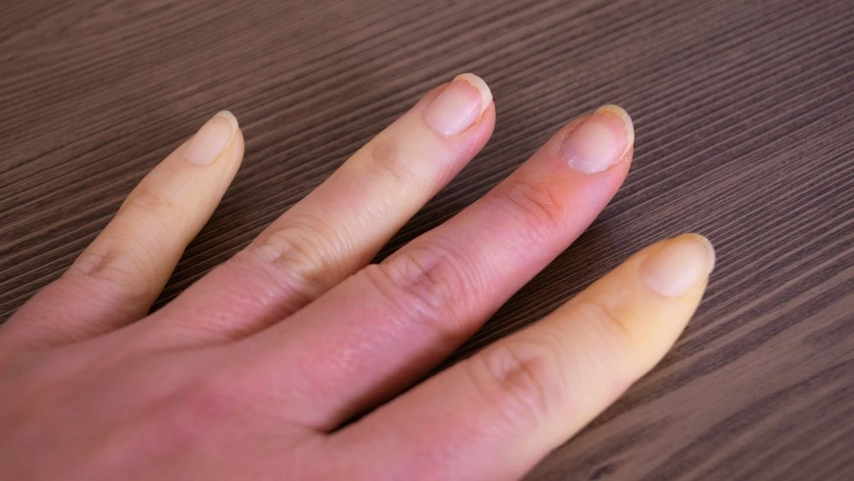 Kış aylarında kadınlarda görülen soğuk çarpması! Özellikle serçe parmak üşümesi 5 Kış aylarında kadınlarda görülen soğuk çarpması! Özellikle serçe parmak üşümesi