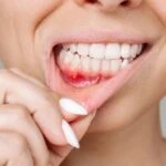 Diş etlerinde çıkan aftlara dikkat! Kanser habercisi olabilir