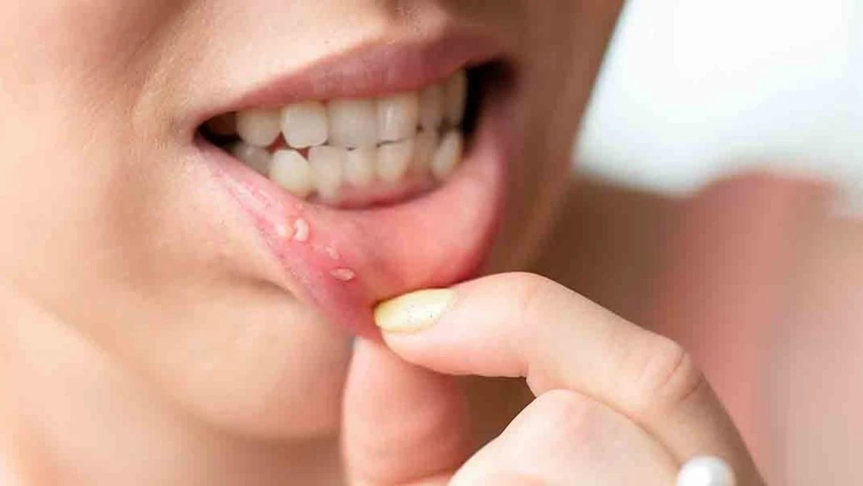 Diş etlerinde çıkan aftlara dikkat! Kanser habercisi olabilir
