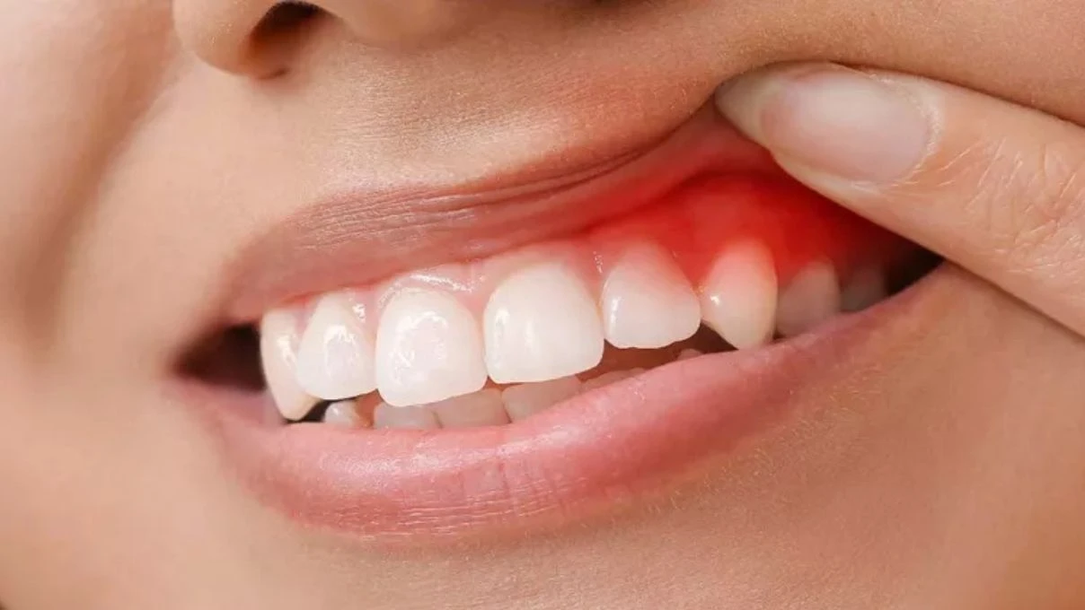 Diş etlerinde çıkan aftlara dikkat! Kanser habercisi olabilir