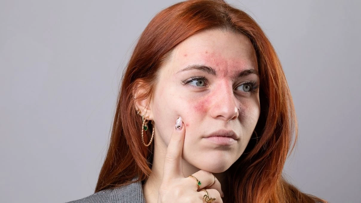 Yüzünüzdeki kızarıklıklara dikkat! Gül hastalığınız olabilir