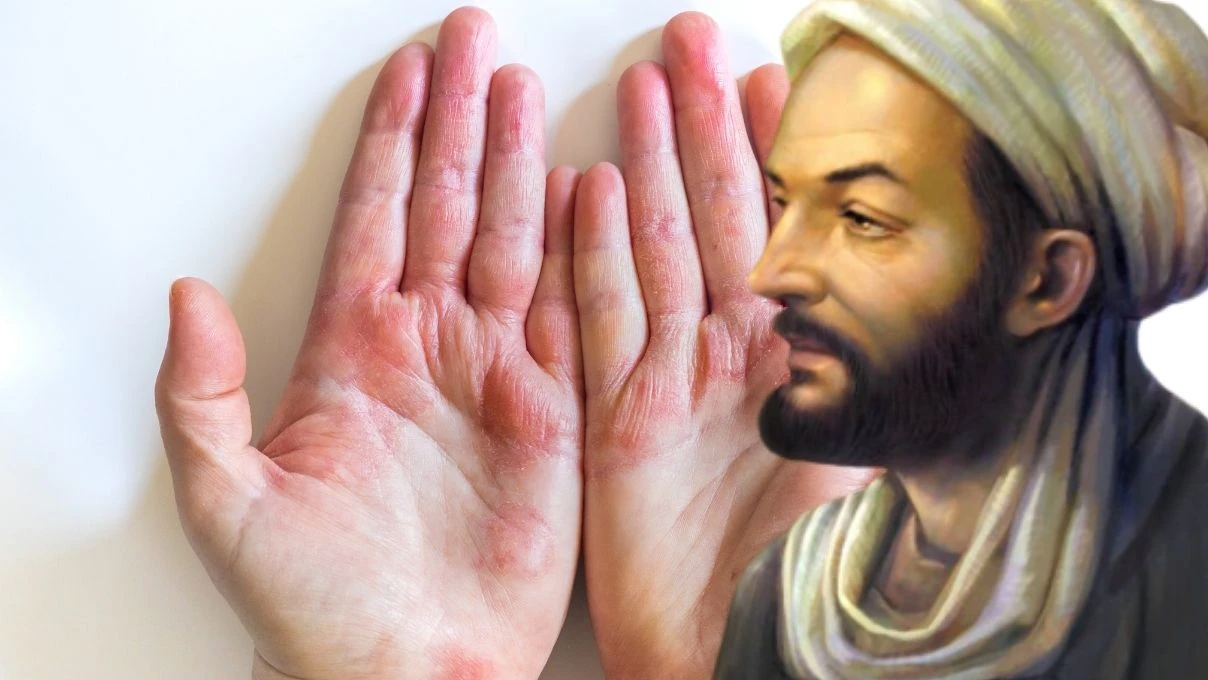 İbn-i Sina’dan egzamaya doğal karışım! 1 günde geçiriyor