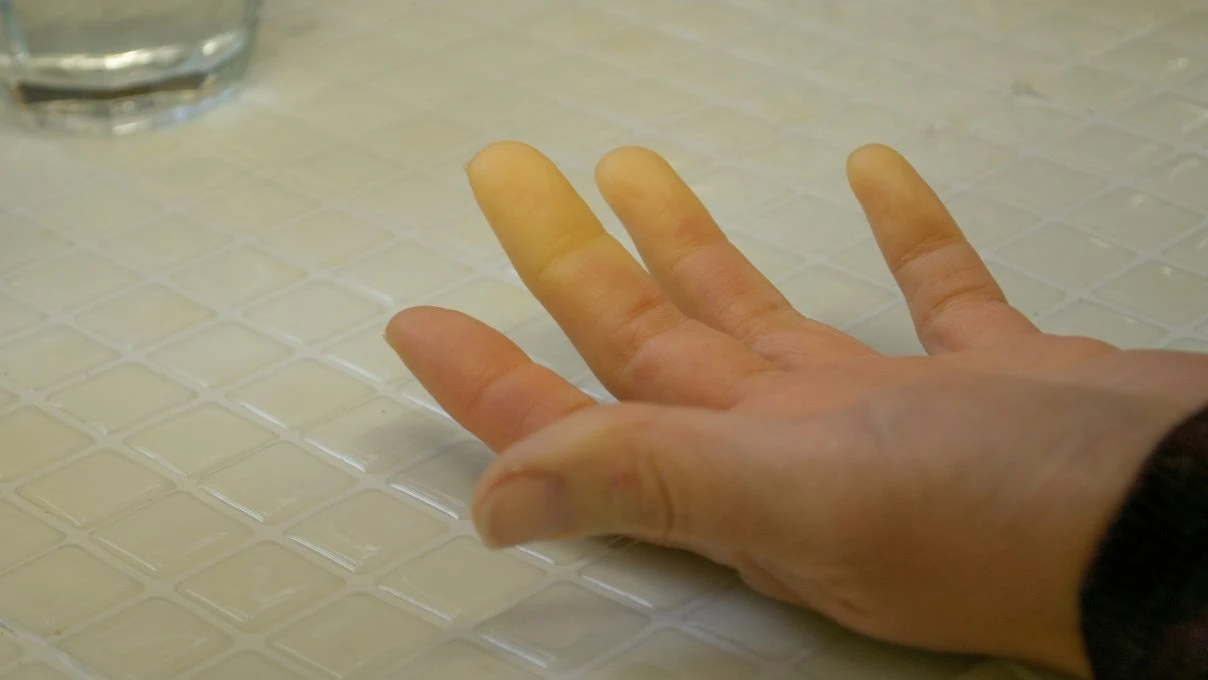 Kış aylarında kadınlarda görülen soğuk çarpması! Özellikle serçe parmak üşümesi 6 Kış aylarında kadınlarda görülen soğuk çarpması! Özellikle serçe parmak üşümesi