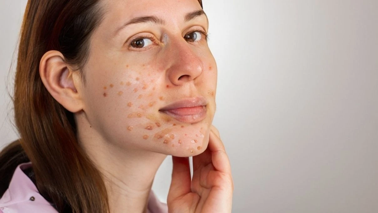 Cilt bakımında kükürt devrimi: Antibakteriyel ve iltihap karşıtı ‘element’ trendi 4 Cilt bakımında kükürt devrimi: Antibakteriyel ve iltihap karşıtı ‘element’ trendi