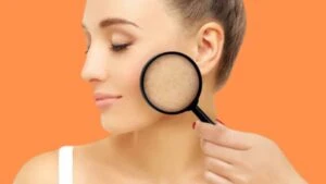 Cilt lekeleri için evde çözüm önerisi!