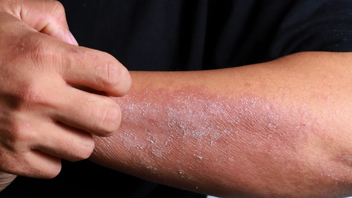 D vitamini eksikliği kışın artıyor dikkat! Uzmanı Dr. Ayda Kart Aşkar uyardı 5 Asli 2025 11 28T123732.978