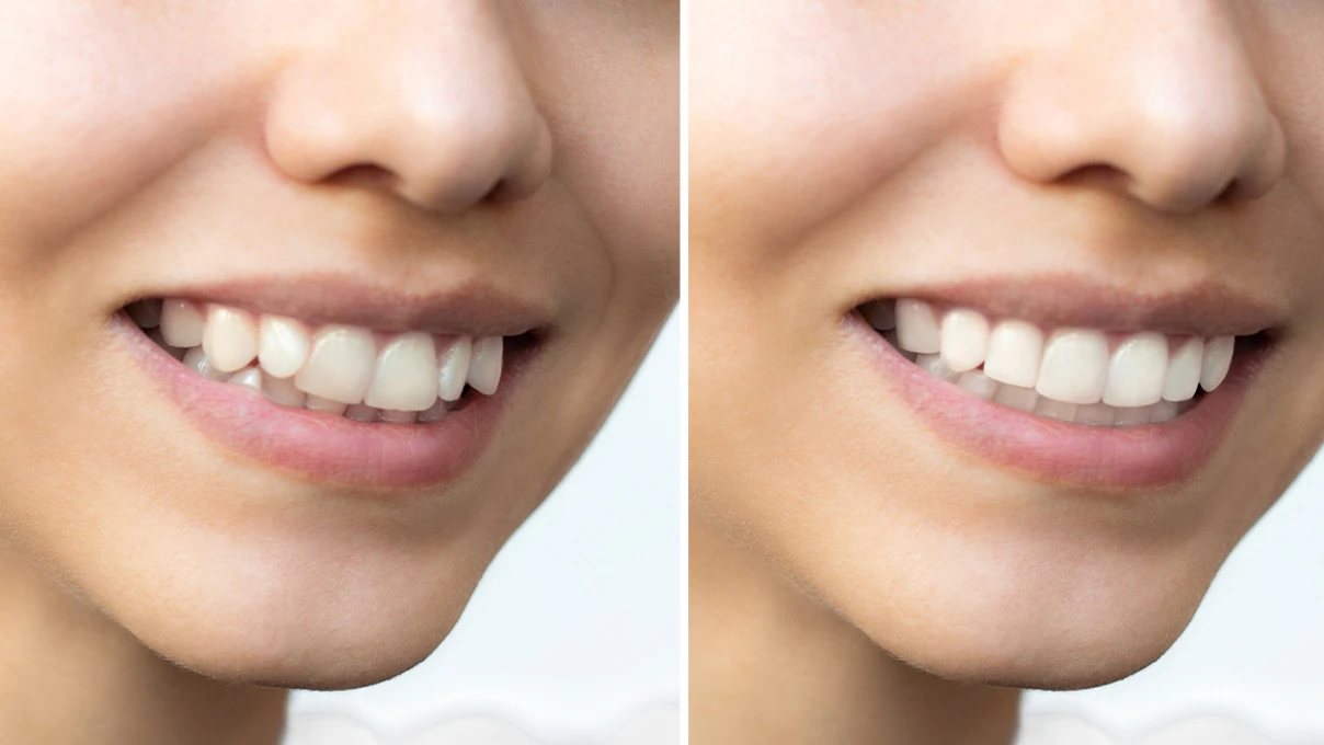 Hollywood Gülüşü Nedir? Dr. Ali Ferhat Karakaş’tan Estetik Diş Hekimliğinde Yeni Trendler 8 Asli 55