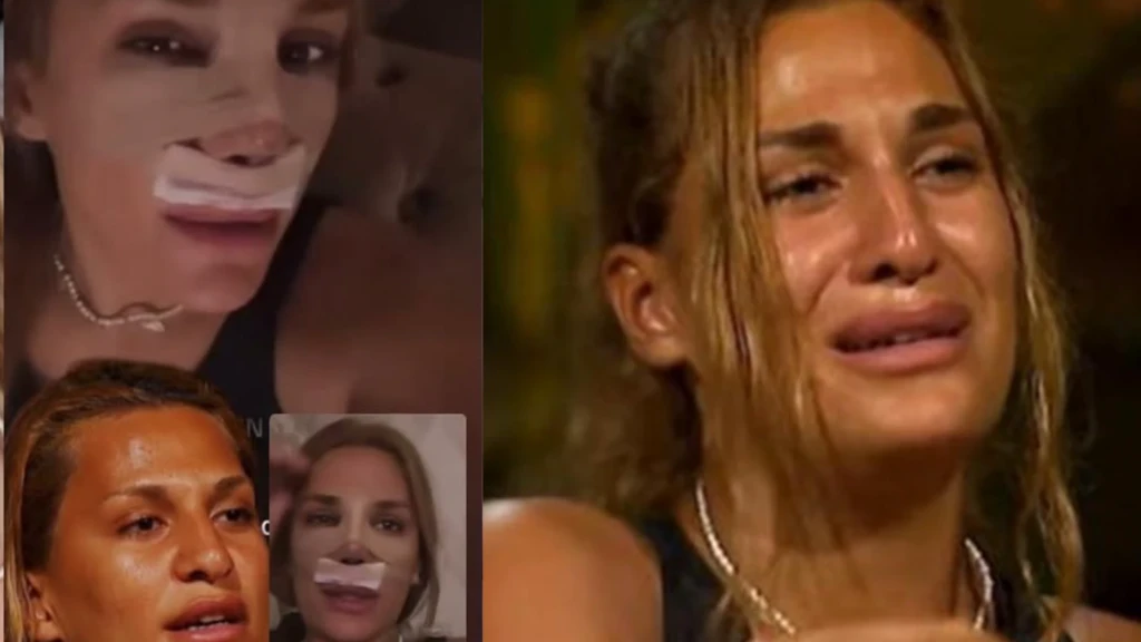 Survivor 2025 yarismacisi Almeda Baylan burun estetigi oldu Iste operasyon sonrasi ilk kare