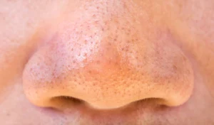 closeup of pores on nose 04df1780 72b4 4f59 8d6e b7812c9e5868