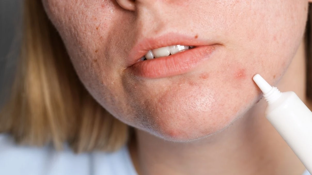 Kırmızı sivilce izleri tarih oluyor! Cildinizi yenileyecek bitkisel serum 