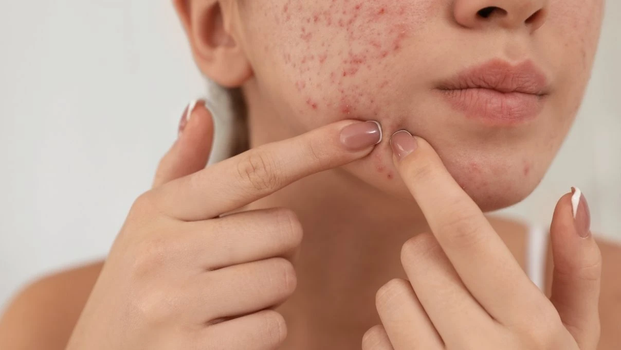 Kırmızı sivilce izleri tarih oluyor! Cildinizi yenileyecek bitkisel serum 