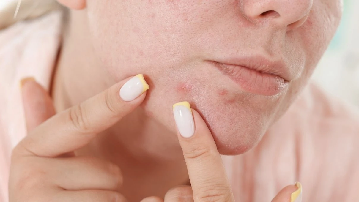 Kırmızı sivilce izleri tarih oluyor! Cildinizi yenileyecek bitkisel serum 