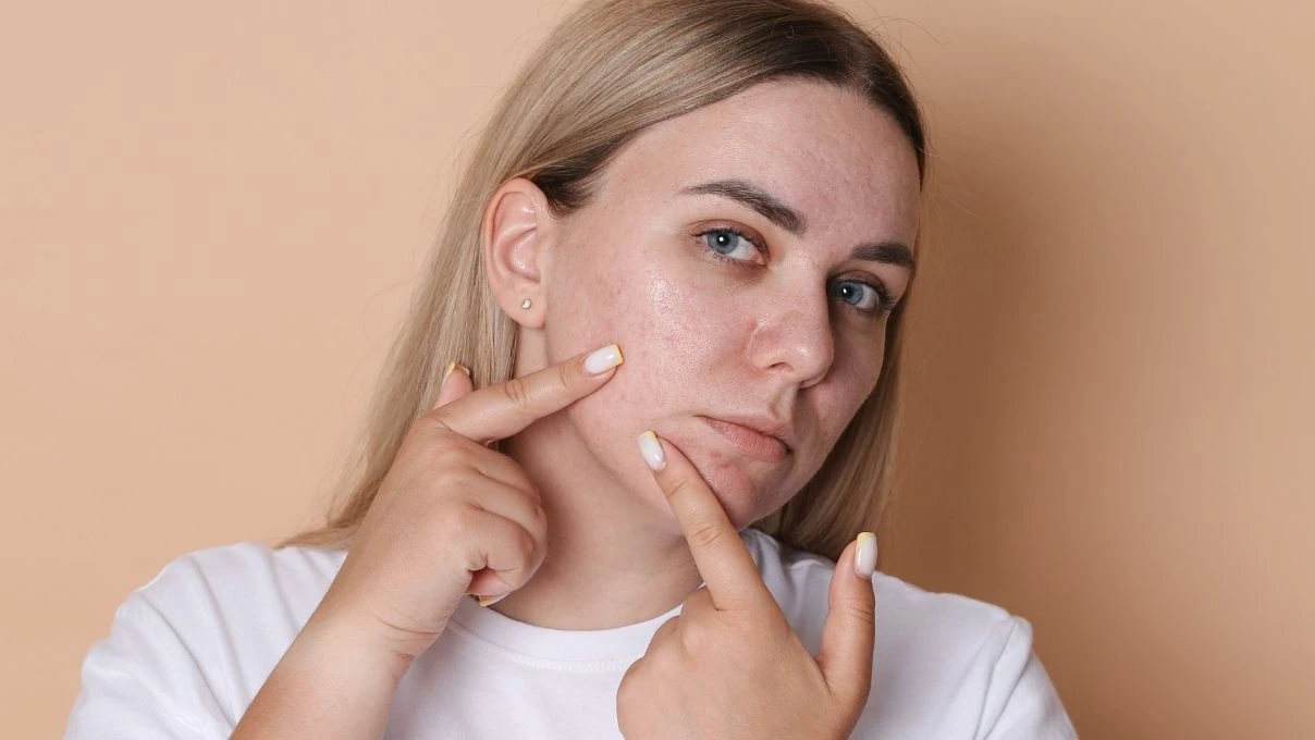 Kırmızı sivilce izleri tarih oluyor! Cildinizi yenileyecek bitkisel serum 