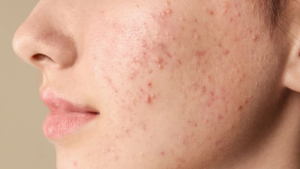 Kırmızı sivilce izleri tarih oluyor! Cildinizi yenileyecek bitkisel serum 