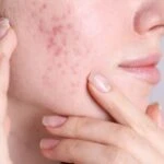 Kırmızı sivilce izleri tarih oluyor! Cildinizi yenileyecek bitkisel serum