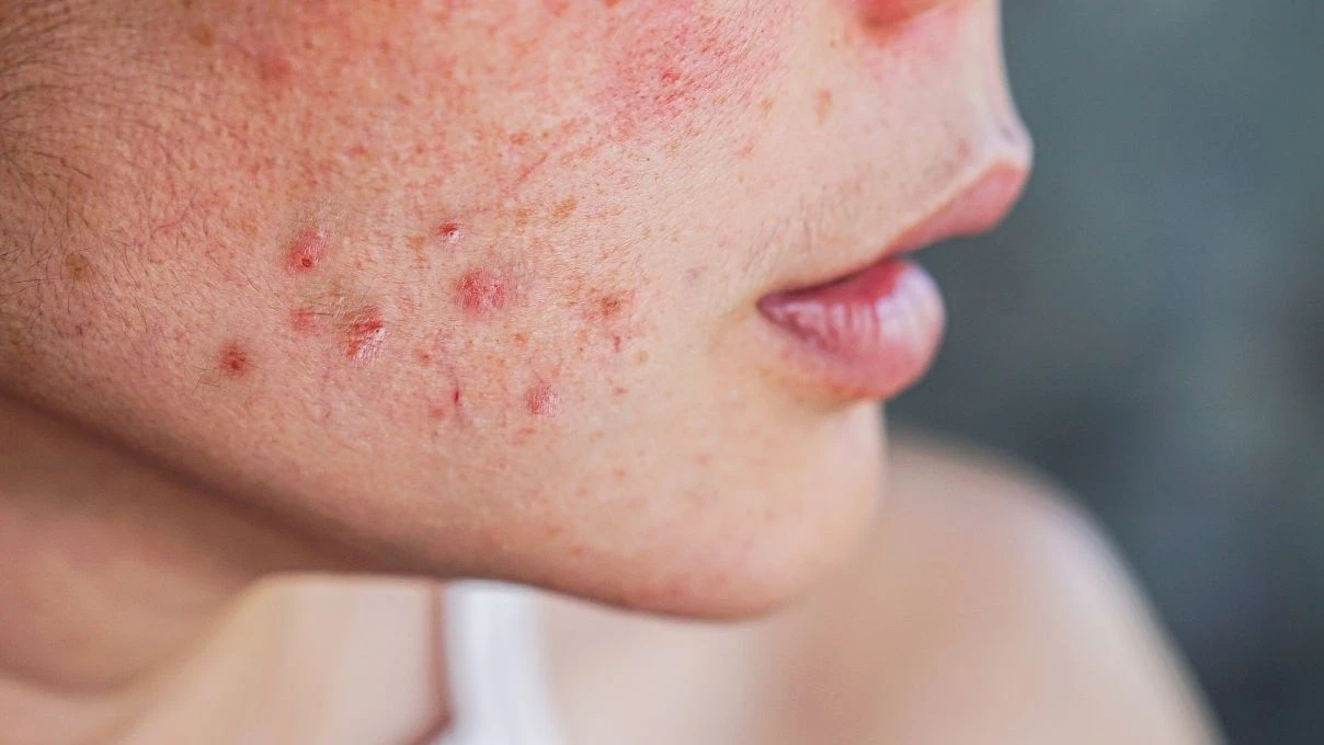 Kırmızı sivilce izleri tarih oluyor! Cildinizi yenileyecek bitkisel serum 