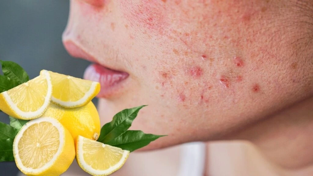 Limon değil limonun kendisi tam bir güzellik sırrı! Vücudunuzdaki lekelerle vedalaşın