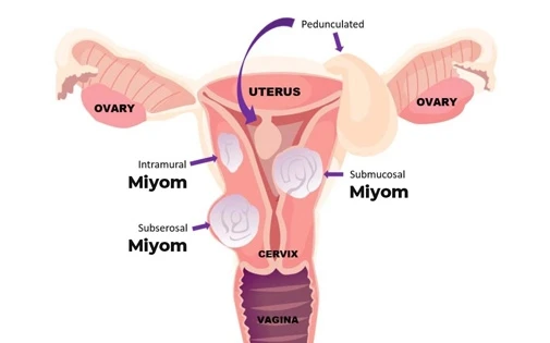 miyom nedir belirtileri tedavisi 45