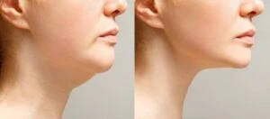 neck lipo vs kybella treatment picosmeticsurgery atlanta 1024x450 1