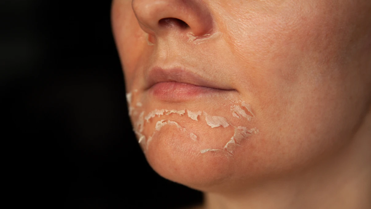 peeling 6