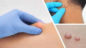 yag bezesi nedir tedavisi nasil yapilir