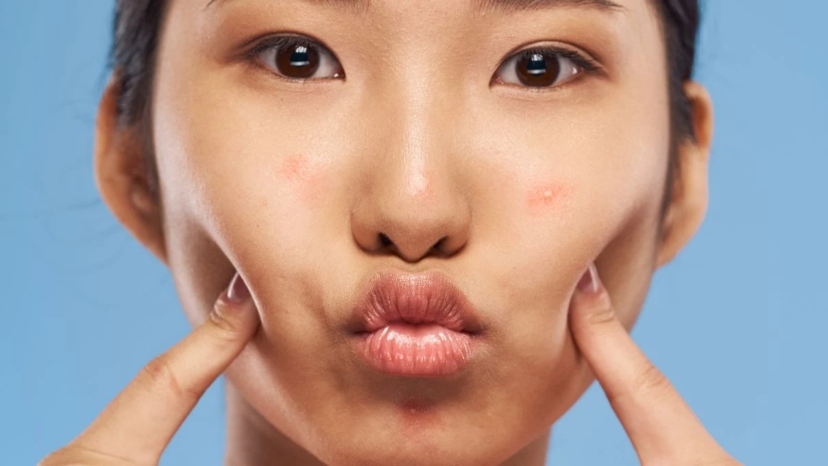 Yüzünüzdeki lekelere son! Sadece 2 malzemeyle çözüm çok basit