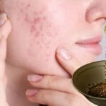 Yüzünüzdeki lekelere son! Sadece 2 malzemeyle çözüm çok basit