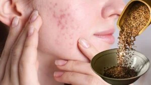 Yüzünüzdeki lekelere son!